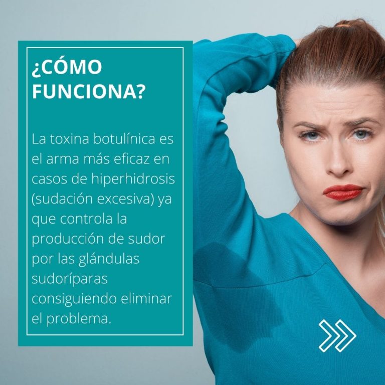 botox contra el sudor